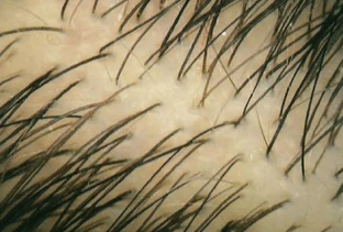Esempio di capelli più folti e densi dopo il trattamento con Folicerin