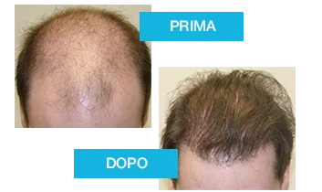 Crescita e densità dei capelli dopo l'uso di Profolan